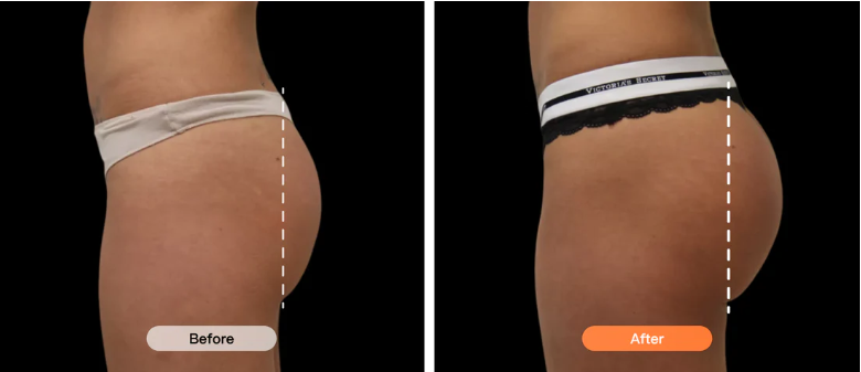 Before and after results showing fuller and more toned hips after using Lumo EMS pants