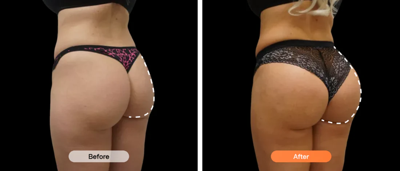 Before and after results showing lifted and toned glutes after using Lumo EMS pants