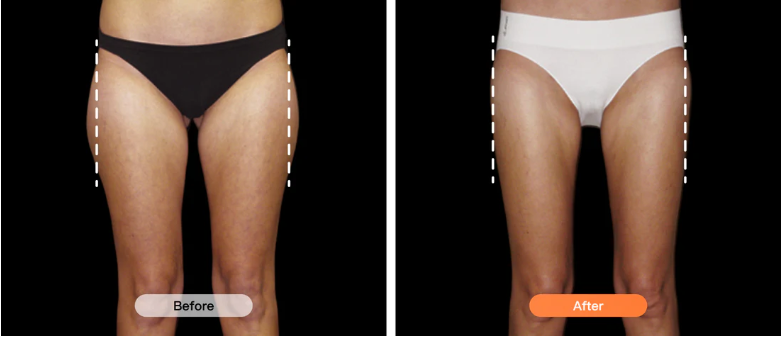 Before and after results showing slimmer, toned thighs after using Lumo EMS slimming pants