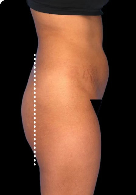 Side body profile of client before using Lumo EMS pants